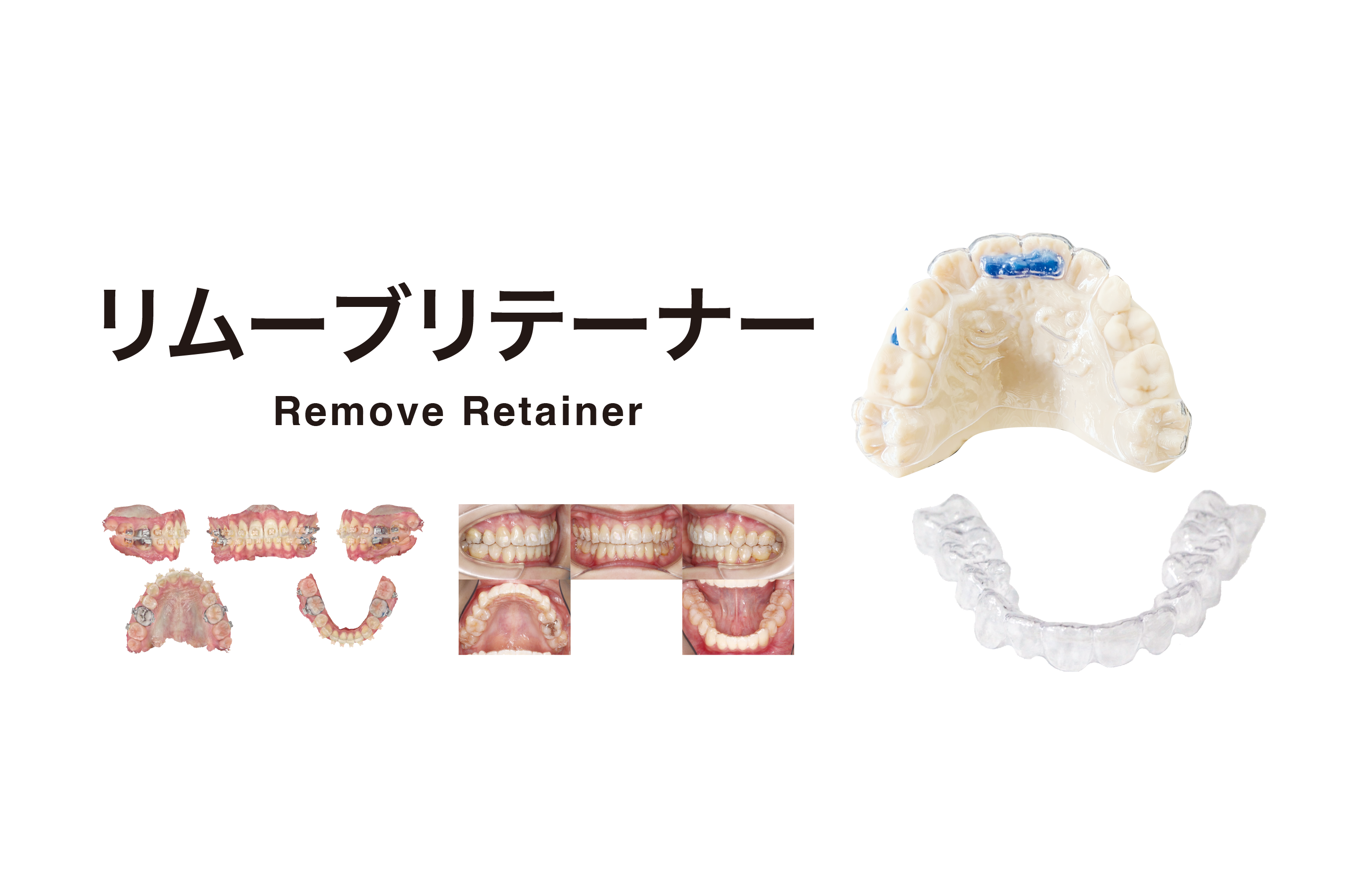 矯正｜アライナー矯正