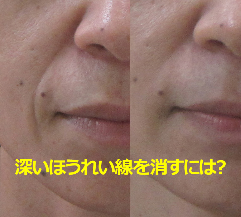 深いほうれい線を解消！】5つのポイントを形成外科専門医が解説