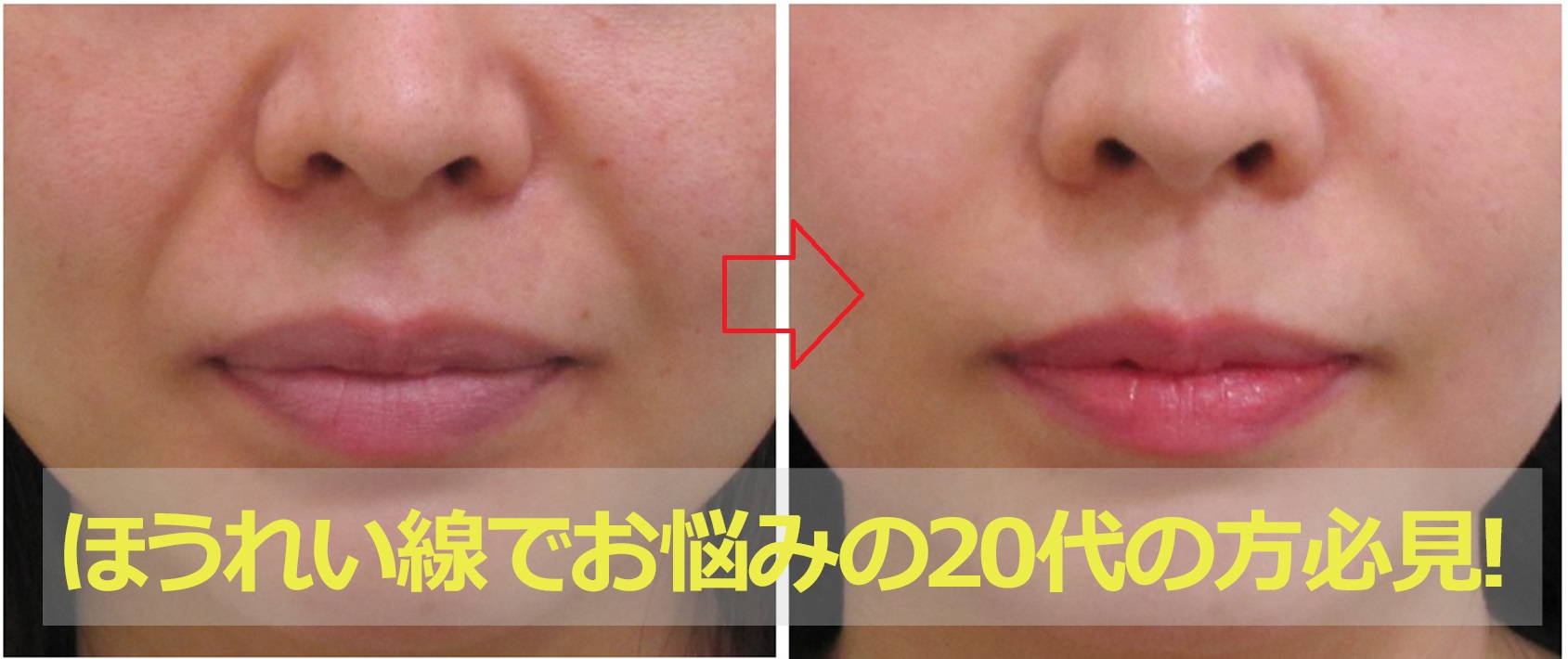 20代のあなたがほうれい線を1回で改善し長期維持する治療