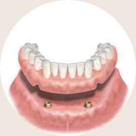 インプラントロケーター | 舟橋歯科クリニック