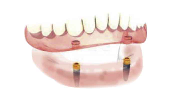 インプラントロケーター | 舟橋歯科クリニック