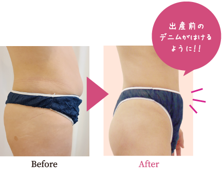 細胞レベルの痩身ダイエット進化した脂肪溶解スペシャルトリートメント