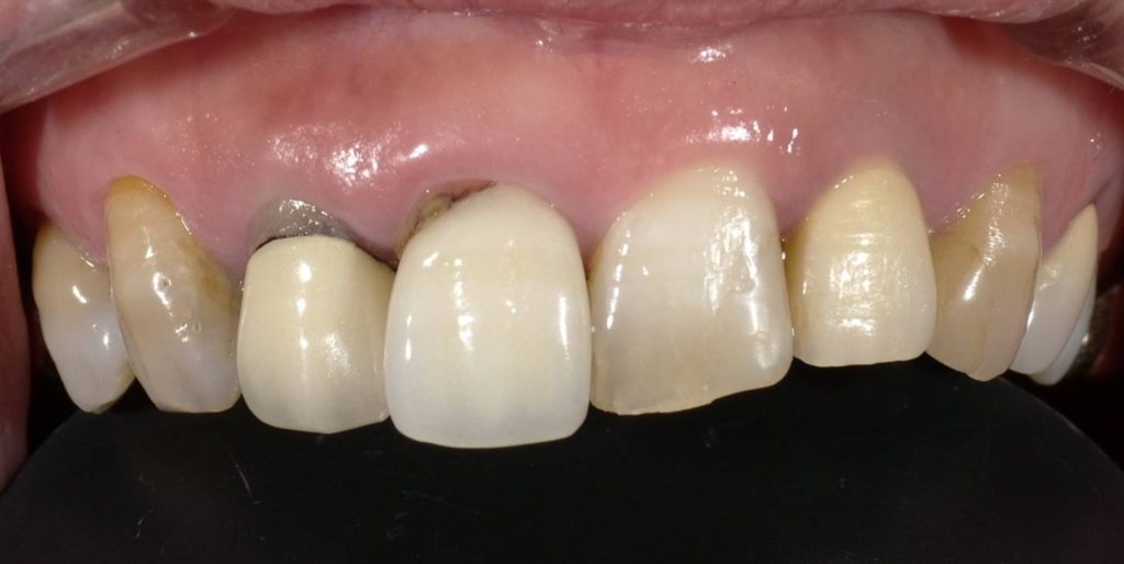 審美修復症例～金属焼付ポーセレン - 高知県四万十市の歯医者なら川村歯科