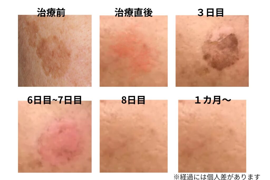 シミ取りピコレーザーの経過を解説！色素沈着と回復期間の全て