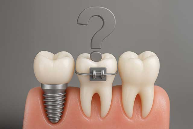 インプラントと矯正治療はどっちを先にしたらいい？｜大阪インプラント