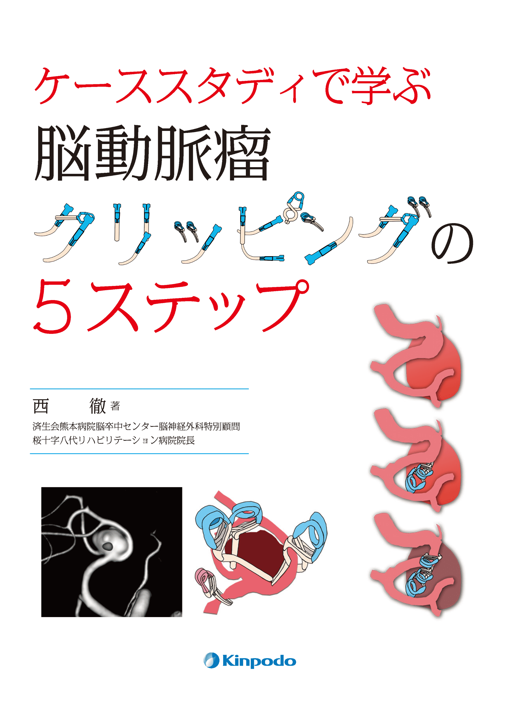 ケーススタディで学ぶ 脳動脈瘤クリッピングの5ステップ - 株式会社 金芳堂