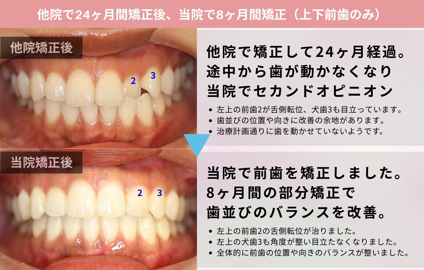 矯正治療の再治療・他院修正 | 東京加悦矯正歯科クリニック銀座医院