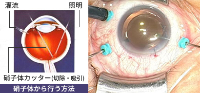 網膜硝子体手術（日帰り手術） | 多治見市の倉知眼科