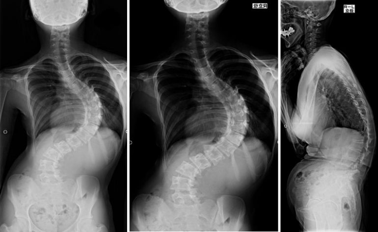 西宮市や芦屋市の側弯症の検査、治療、装具｜くらかわ整形外科・耳鼻咽喉科