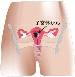 子宮体がんについて｜京都済生会病院