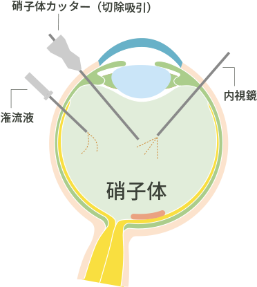 硝子体手術 | 医療法人増進会 本田眼科クリニック