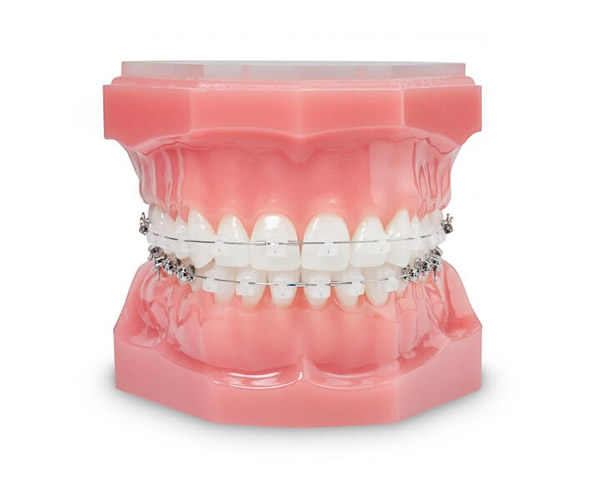 16.5万円～「マウスピース矯正/ワイヤー矯正（表・裏）」｜三ノ輪駅1分