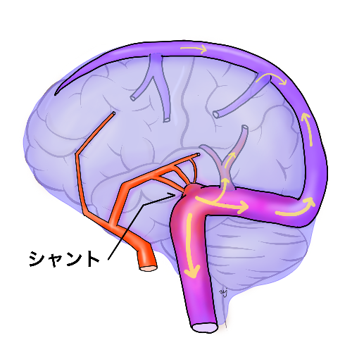 硬膜動静脈廔／藤枝市立総合病院