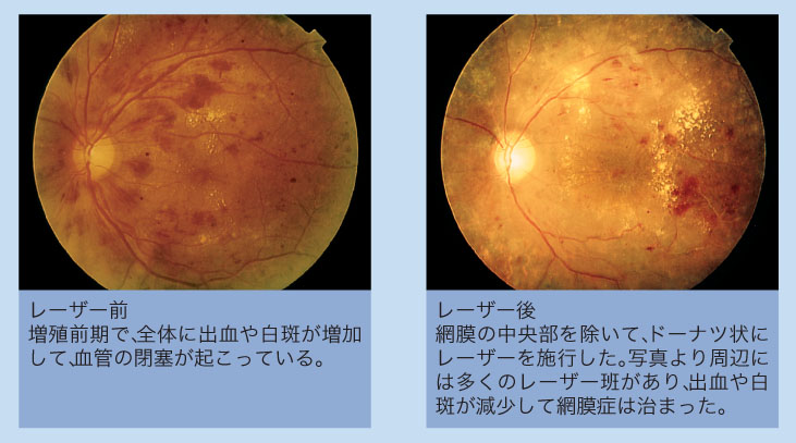 糖尿病網膜症について｜網膜硝子体｜病名と症例｜林眼科病院｜福岡市