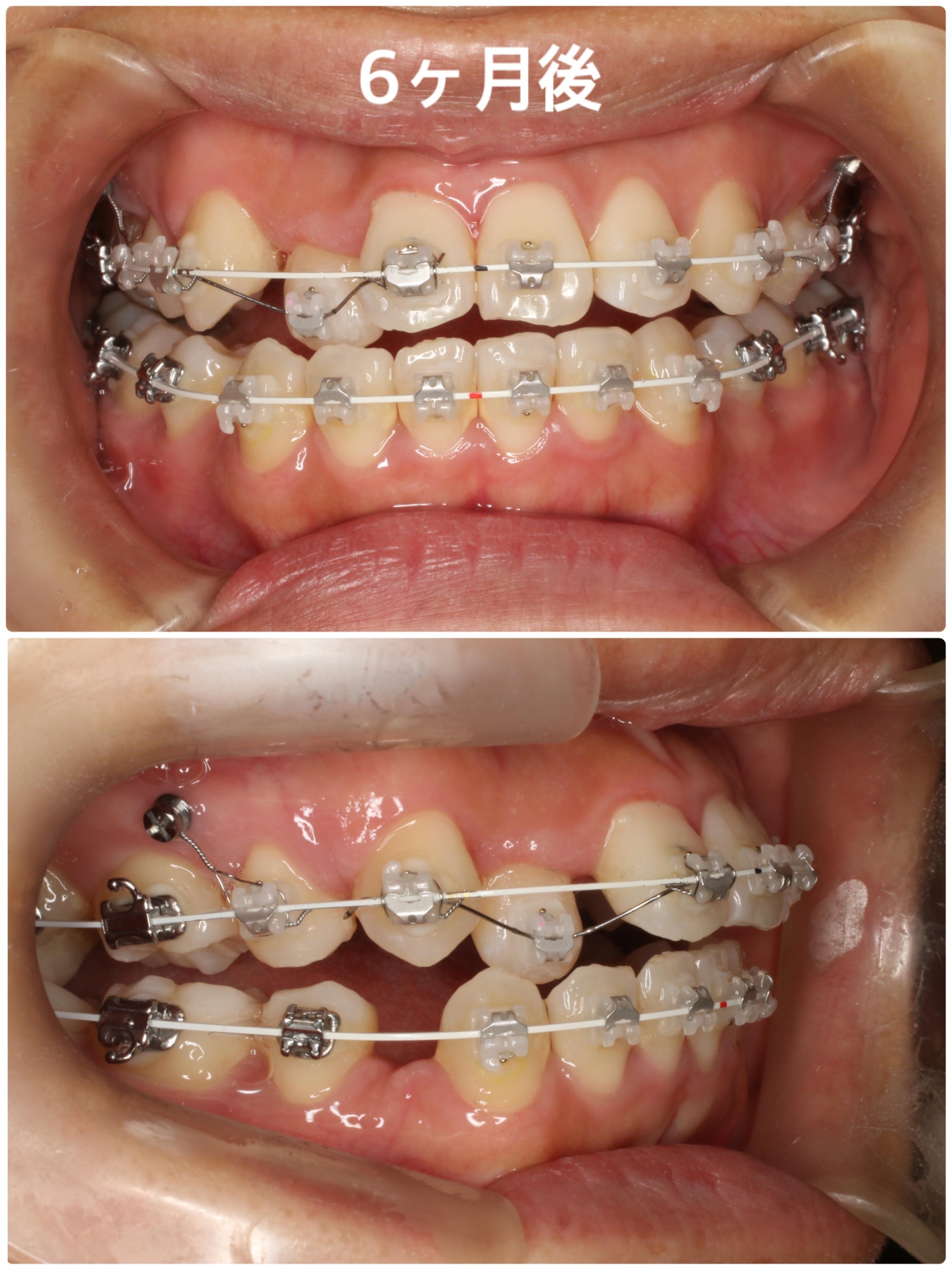 表側矯正症例】歯の叢生（凸凹）が気になる・交叉咬合 | 博多キュア