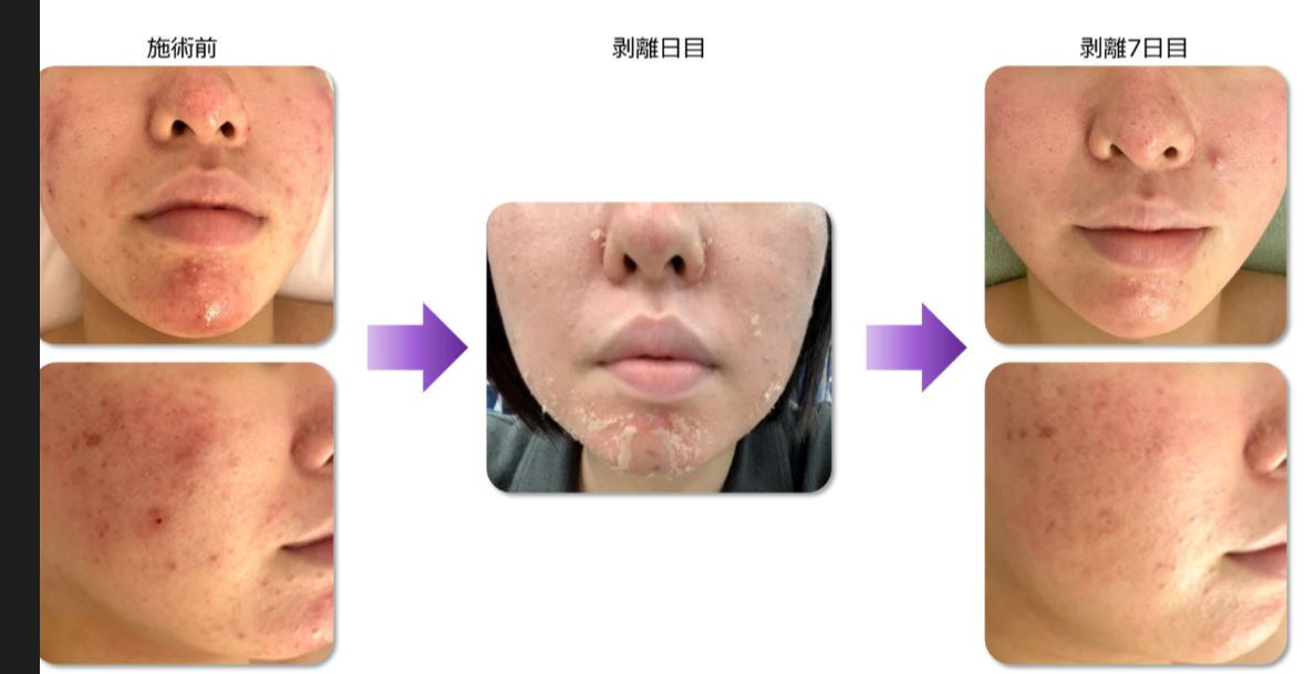 ハーブピーリング剥離ありに関する再生美容サロン「鹿児島日置市伊集院