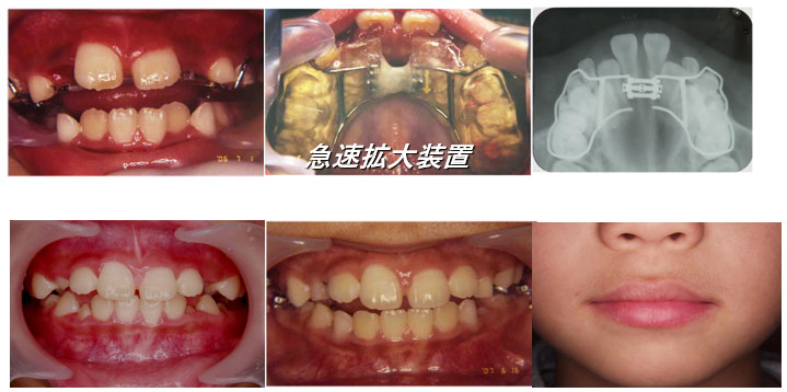 咬合育成の活用 MFT（顎顔面治療）のトレーニング方法を使用した小児