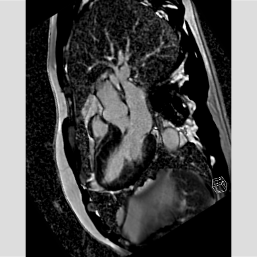心臓MRI｜榊原記念病院