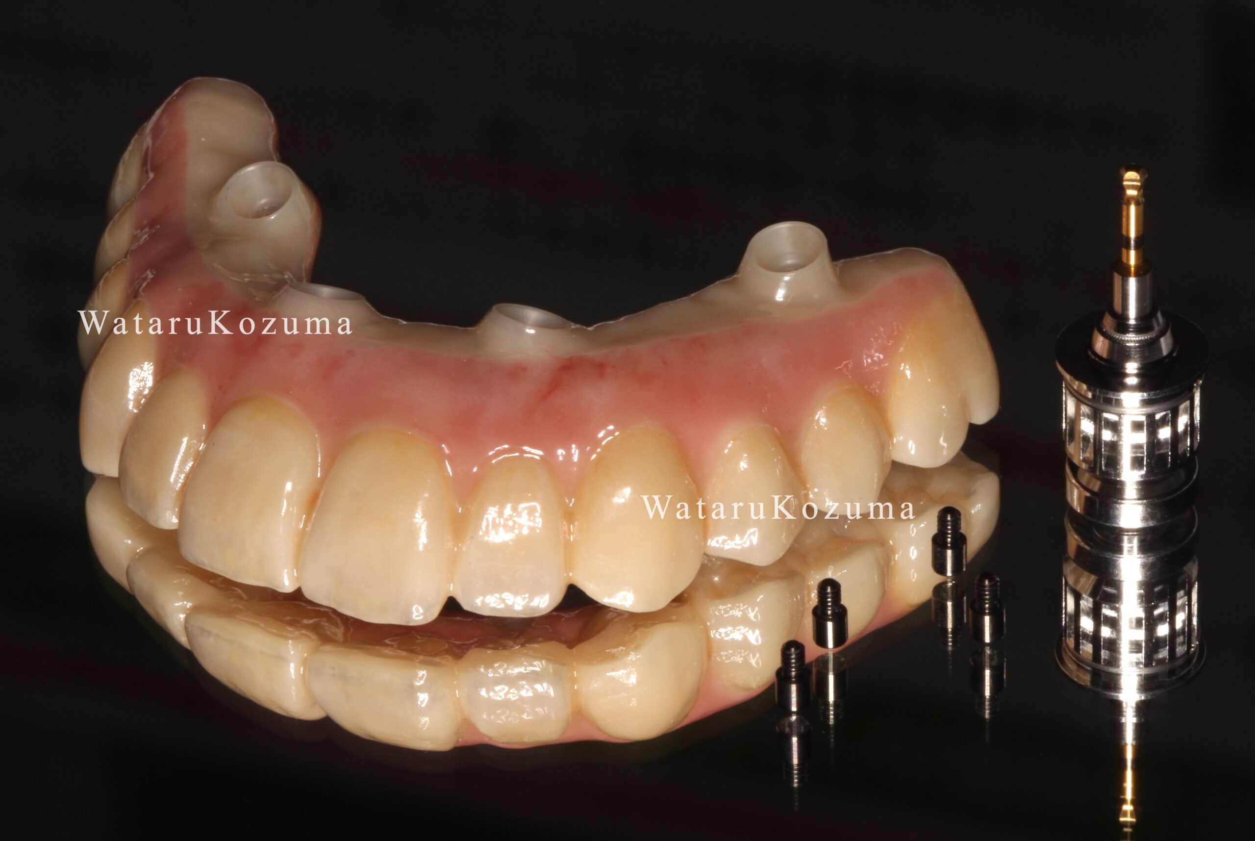 All-on-4（オールオン4）/ 無歯顎インプラント症例｜インプラント