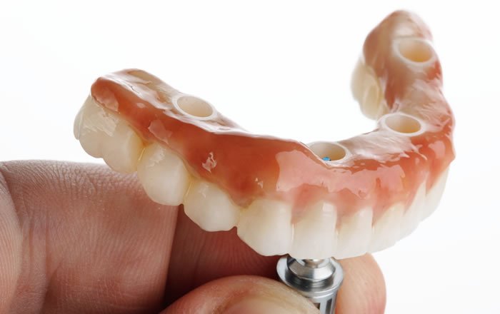 ♧裁断済 インプラントオーバーデンチャーの基本と臨床 インプラント