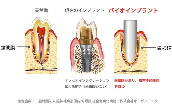 バイオインプラントについて～歯根膜再生を目指す次世代治療の研究と