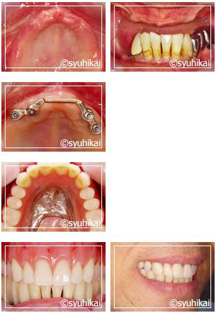 歯をすべて失った時のインプラント症例 | インプラントネット