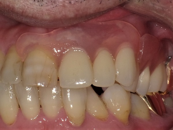 上顎多数歯欠損インプラント症例｜症例解説｜東京銀座シンタニ