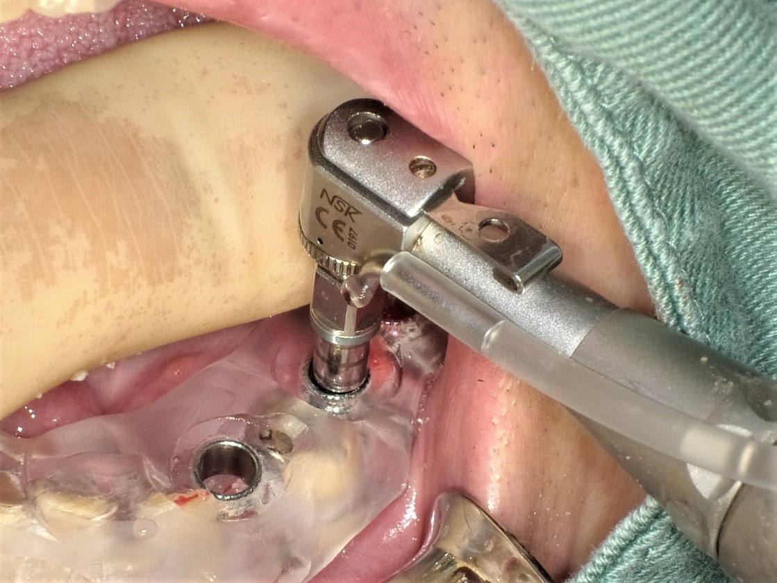 下顎多数歯欠損インプラント症例｜症例解説｜東京銀座シンタニ