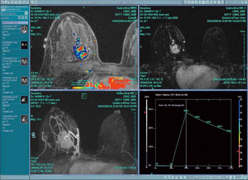 MRI－Women's Healthに対するトータルコンセプト“Elite Breast”－技術