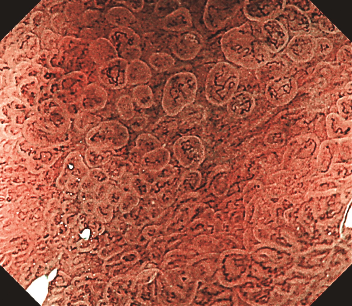 医学界新聞プラス ［第2回］H. pylori 除菌後胃癌――非腫瘍上皮の被覆