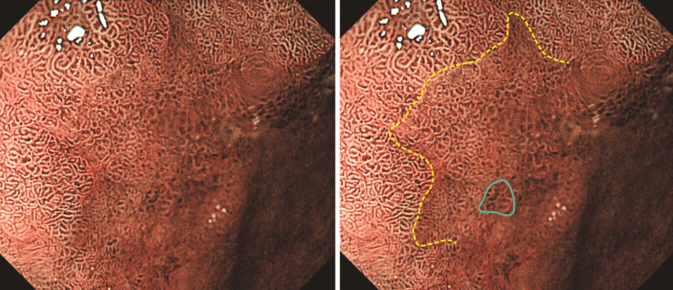 医学界新聞プラス ［第2回］H. pylori 除菌後胃癌――非腫瘍上皮の被覆