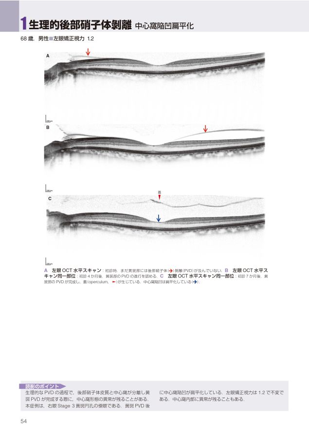 OCTアトラス_第2版_立読み