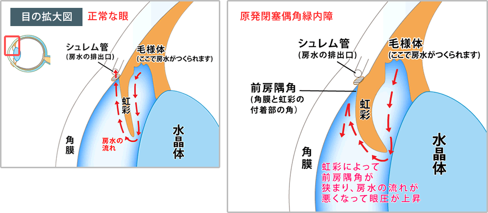 原発閉塞隅角緑内障 | 池袋サンシャイン通り眼科診療所