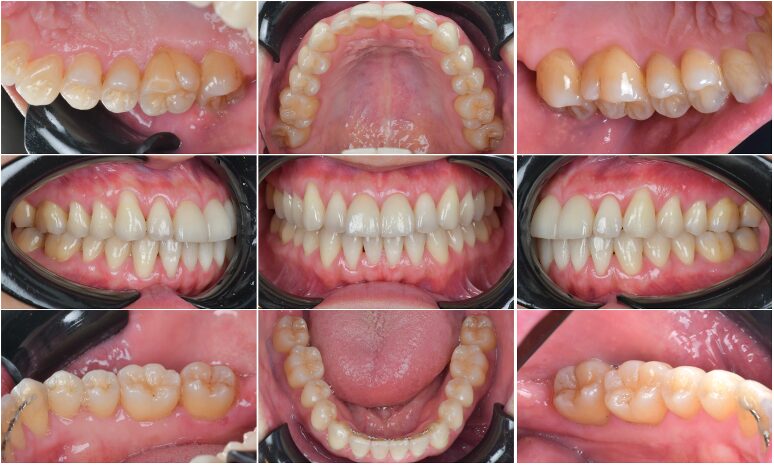 歯がボロボロ」で悩んでいる方へ｜池田デンタルオフィス静岡