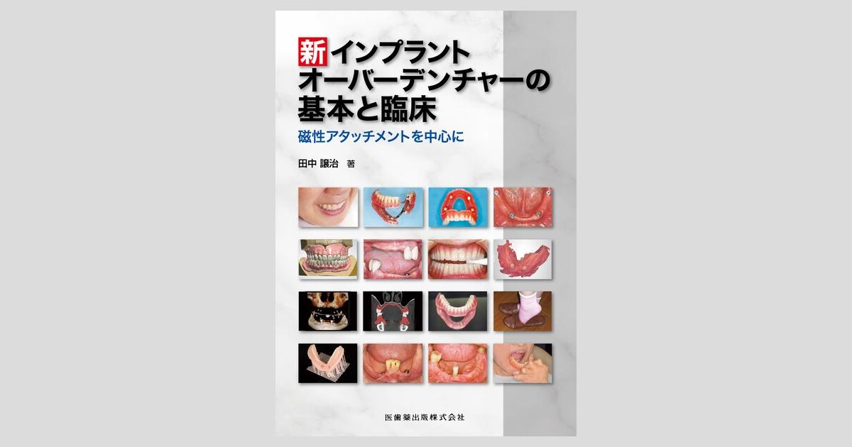 新インプラントオーバーデンチャーの基本と臨床 磁性アタッチメントを