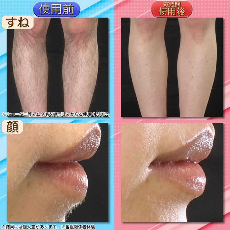 ReFa EPI GO(リファ エピ ゴー)／光美容器／ムダ毛ケア | MBC