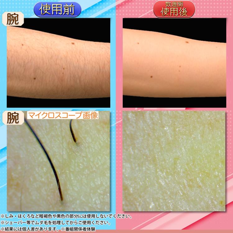 ReFa EPI GO(リファ エピ ゴー)／光美容器／ムダ毛ケア | MBC