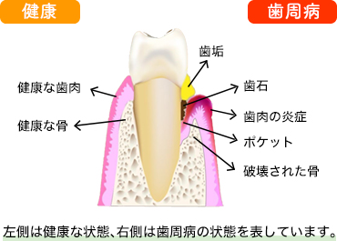 日本臨床歯周病学会 | 歯周病とは？
