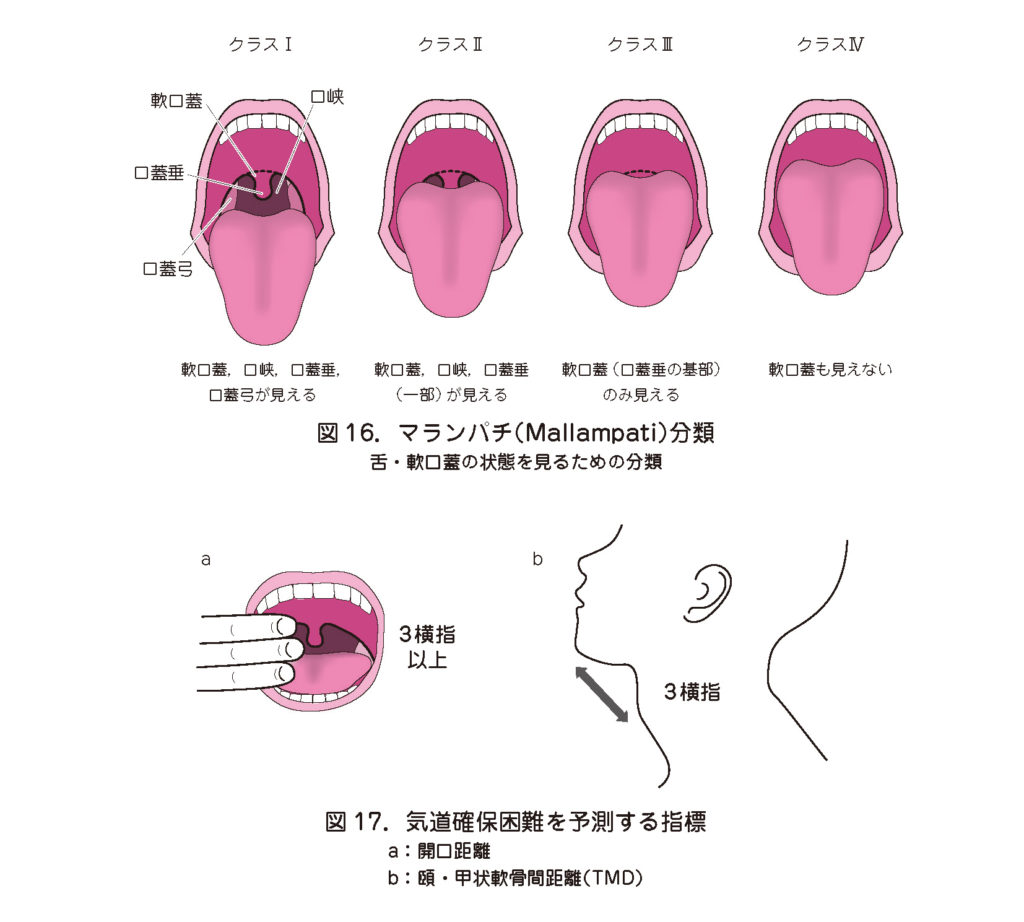 Q1．脊髄くも膜下麻酔（脊椎麻酔）が成功しない場合の対応は？ – 日本