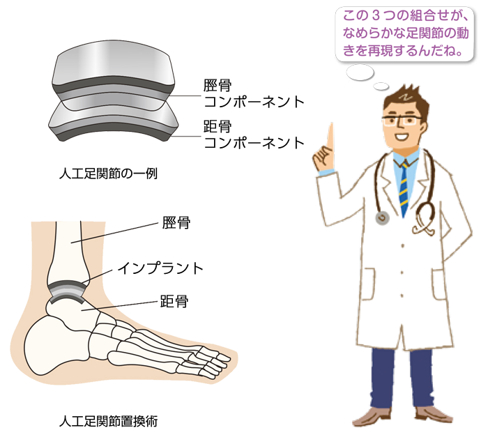 人工足関節置換術とは｜人工足関節について｜人工関節とは｜人工関節