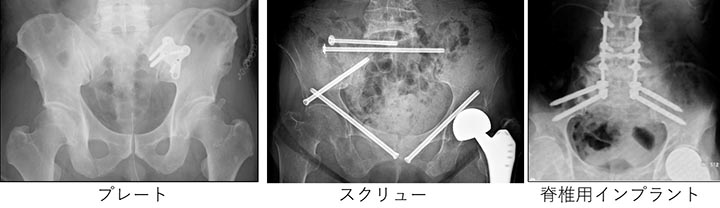 高齢者の骨盤骨折｜一般社団法人 日本整形外傷学会 骨折の解説