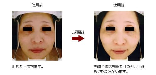 メラフェードでスキンケア｜京都・滋賀の大西皮フ科形成外科医院【大津