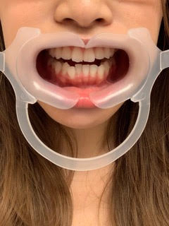 加速装置を使用します！ | 板橋駅すぐの歯医者｜ワイズ板橋歯科 おとな