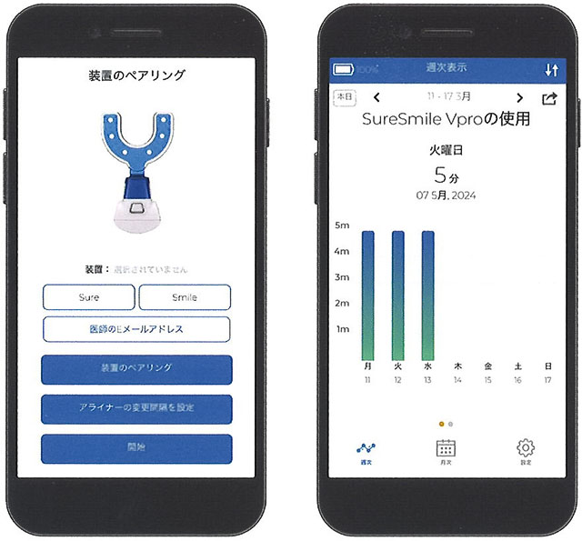 シュアスマイルVPro（振動型アライナー補助装置）｜大阪矯正歯科グループ