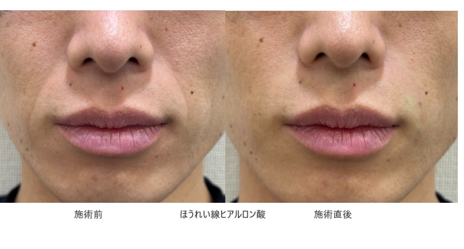 若いのにほうれい線が目立つ人の特徴と対策方法