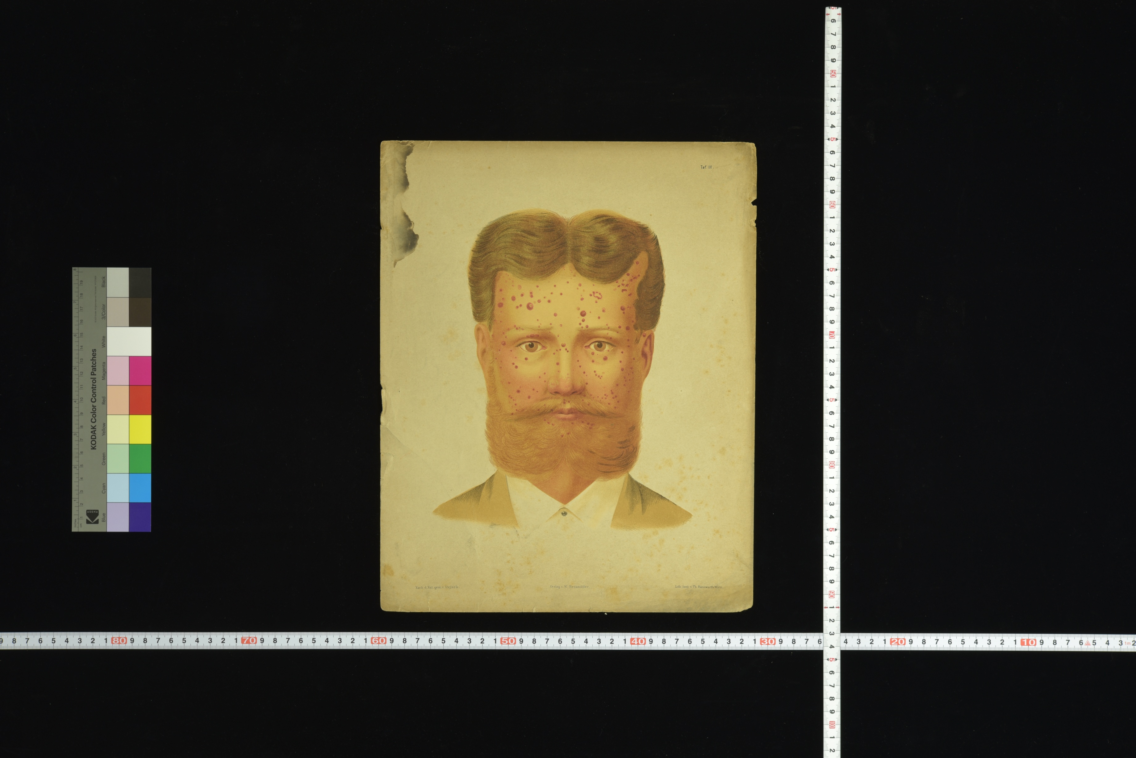 第8章 皮膚科学教室旧蔵皮膚病図譜 | 九州大学附属図書館