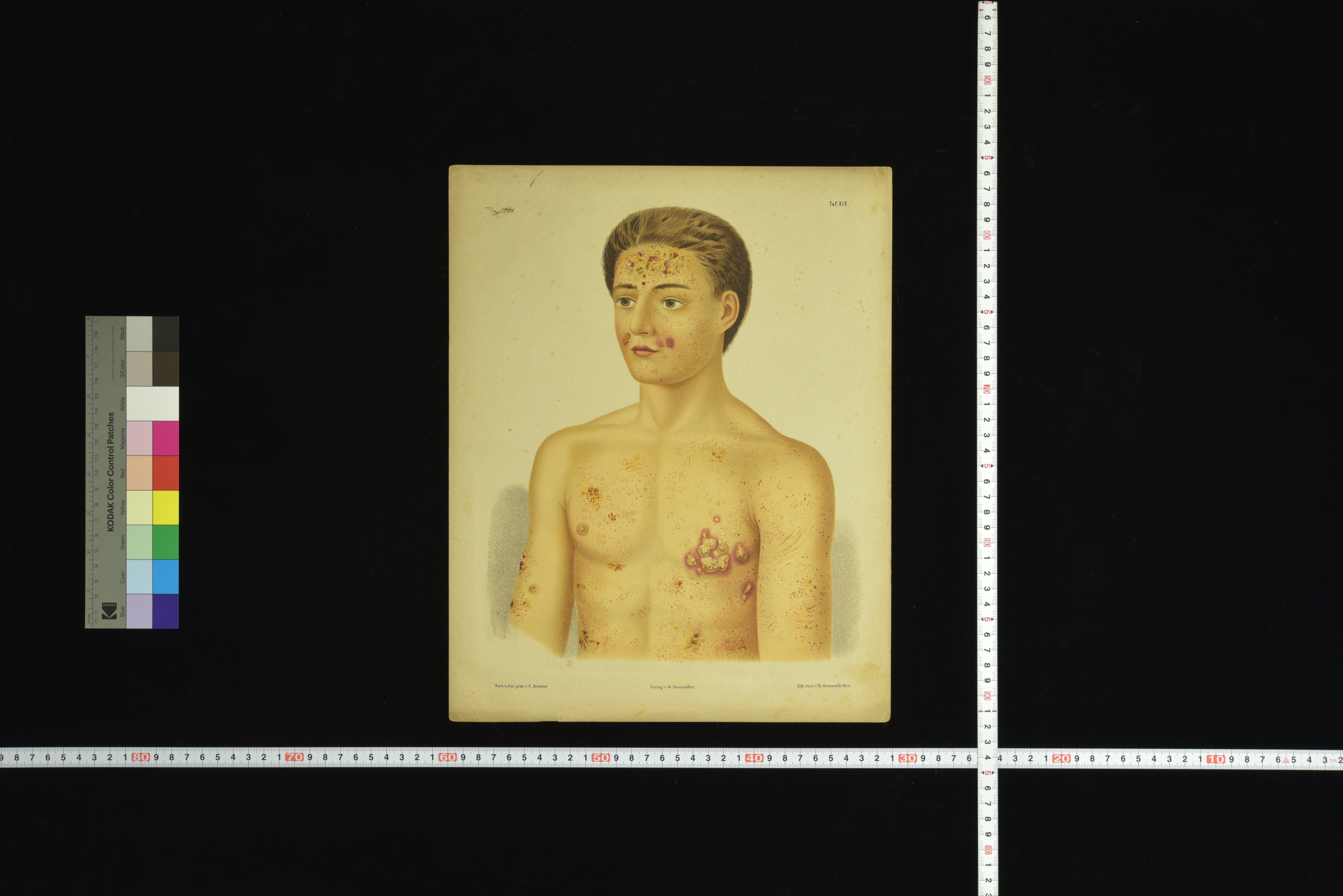 第8章 皮膚科学教室旧蔵皮膚病図譜 | 九州大学附属図書館