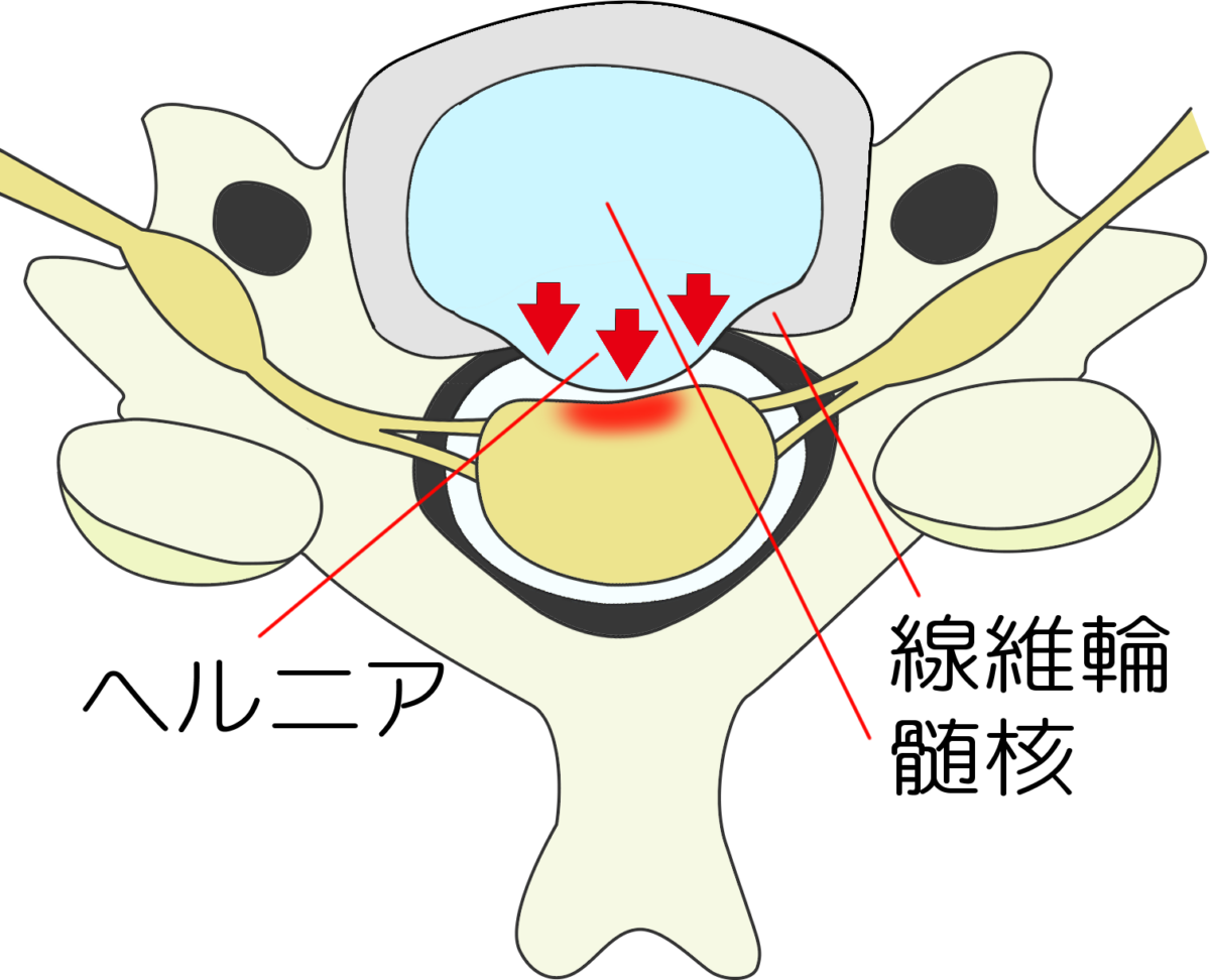 頚椎椎間板ヘルニアについて - 岐阜市 - 森整形外科リハビリクリニック
