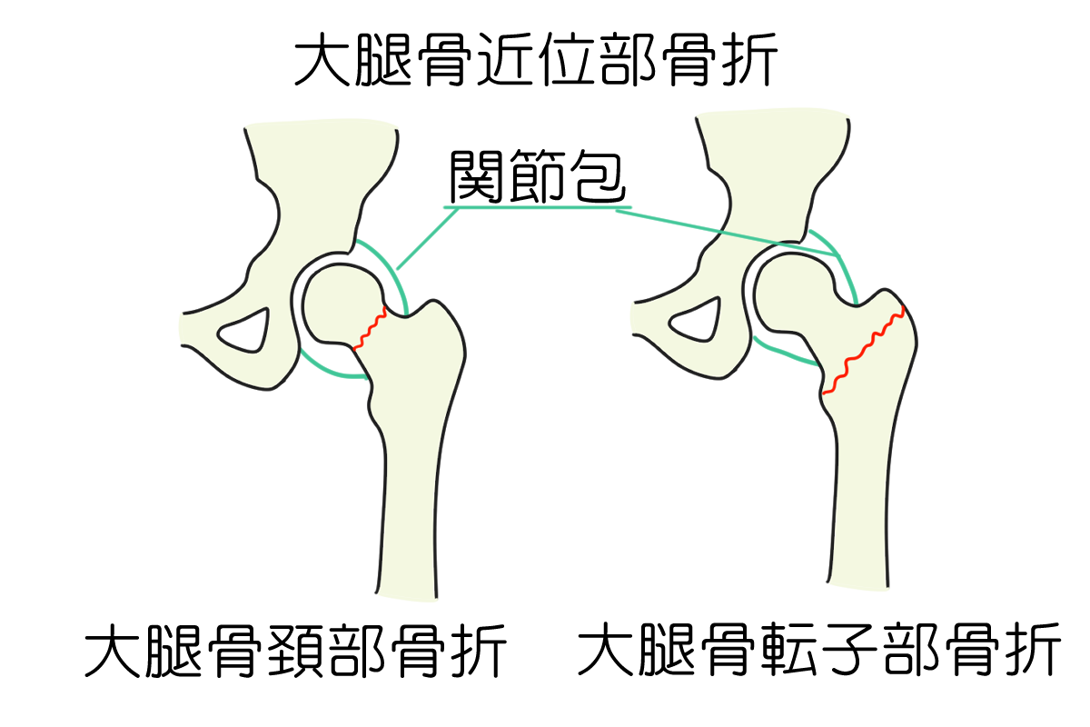 大腿骨近位部骨折について - 岐阜市 - 森整形外科リハビリクリニック