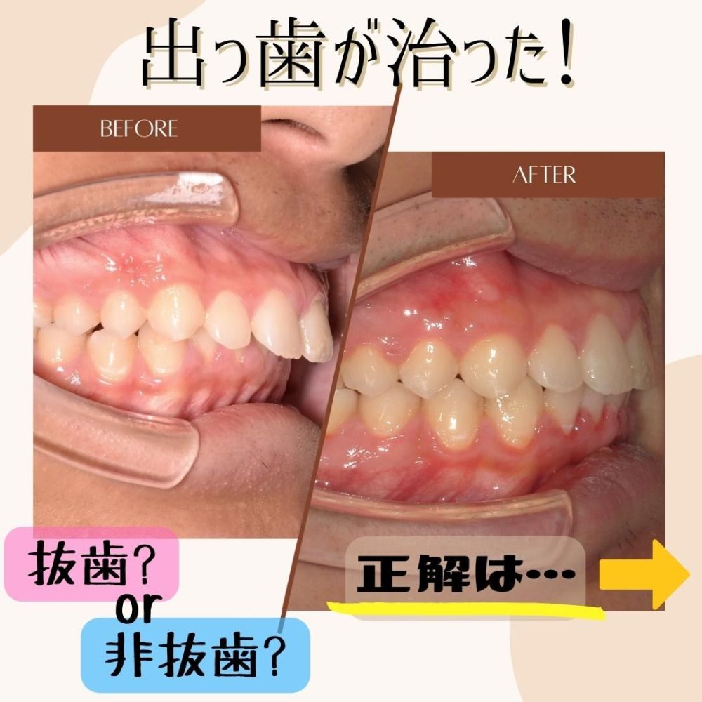 症例】非抜歯矯正～出っ歯～ | マロニエ矯正歯科クリニック
